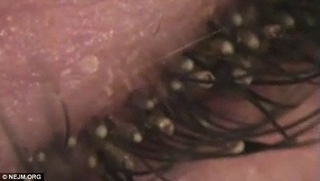 Video shows hundreds of PUBIC LICE living in six year old boy's eyelashes