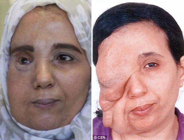 NEUROFIBROMATOSIS: THE 'ELEPHANT MAN' CONDITION NEUROFIBROMATOSIS: THE 'ELEPHANT MAN' CONDITION