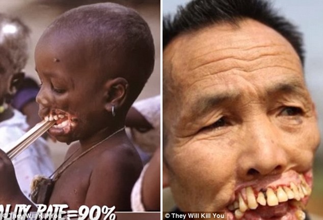Check out the top 10 scariest diseases: The 10 scariest diseases revealed, from worms burrowing into eyes to bacteria that rots the cheeks to the BONE
