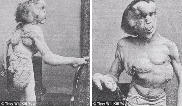 Check out the top 10 scariest diseases: The 10 scariest diseases revealed, from worms burrowing into eyes to bacteria that rots the cheeks to the BONE