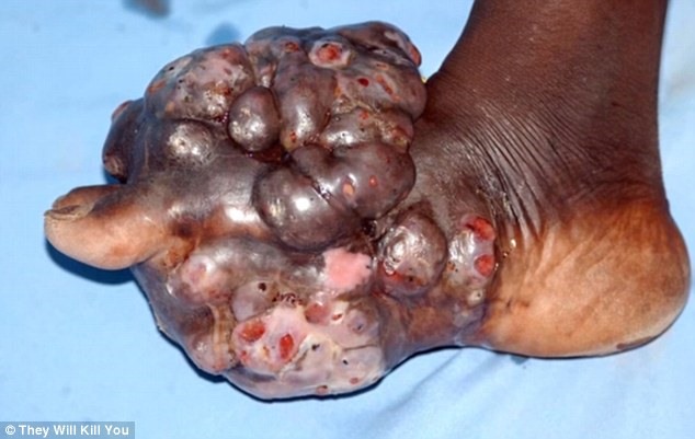 Check out the top 10 scariest diseases: The 10 scariest diseases revealed, from worms burrowing into eyes to bacteria that rots the cheeks to the BONE