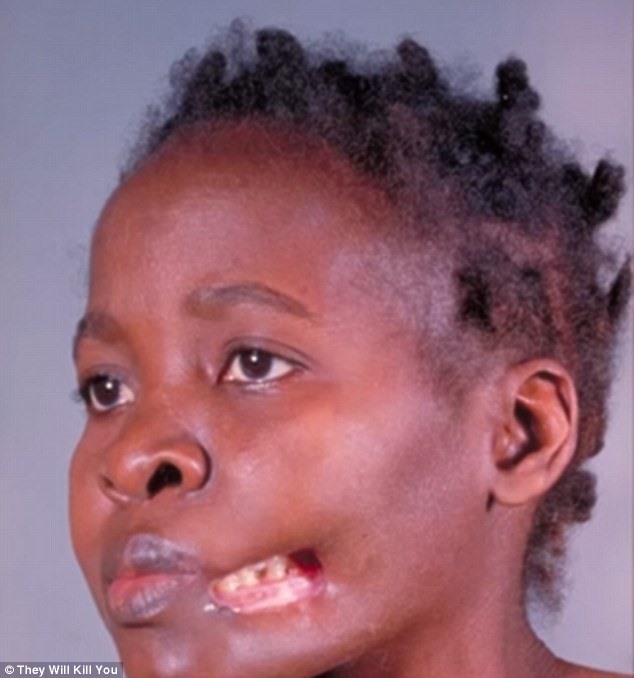 Check out the top 10 scariest diseases: The 10 scariest diseases revealed, from worms burrowing into eyes to bacteria that rots the cheeks to the BONE