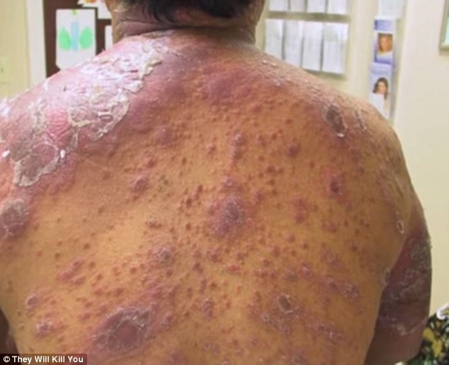Check out the top 10 scariest diseases: The 10 scariest diseases revealed, from worms burrowing into eyes to bacteria that rots the cheeks to the BONE
