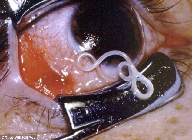 Check out the top 10 scariest diseases: The 10 scariest diseases revealed, from worms burrowing into eyes to bacteria that rots the cheeks to the BONE