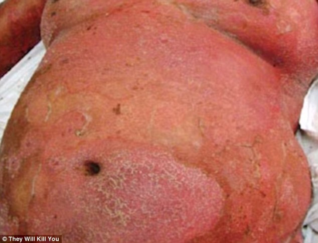 Check out the top 10 scariest diseases: The 10 scariest diseases revealed, from worms burrowing into eyes to bacteria that rots the cheeks to the BONE