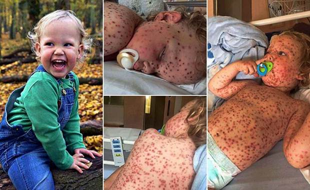 HEALT- CHICKENPOX: WHAT THE NHS ADVISES (Video)