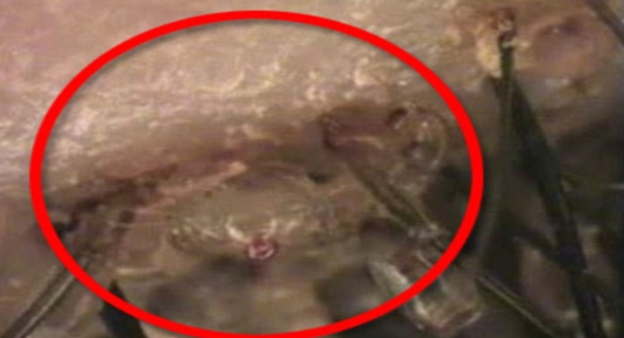 Video shows hundreds of PUBIC LICE living in six year old boy's eyelashes Video shows hundreds of PUBIC LICE living in six year old boy's eyelashes