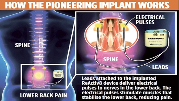 The remote-controlled implant that uses electric shocks to 'wake up'