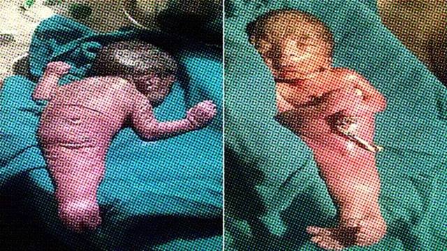 The real life MERMAID: Mermaid syndrome – What is the mermaid syndrome?