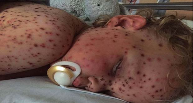 HEALT- CHICKENPOX: WHAT THE NHS ADVISES (Video)