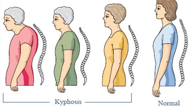 Skolyoz: hastalığın erken teşhisinin tedavide çok büyük önemi var 