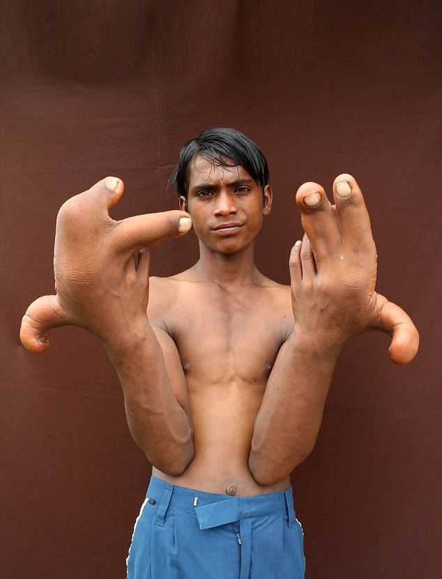 What İs Elephant Foot Diseasa? (Healt)