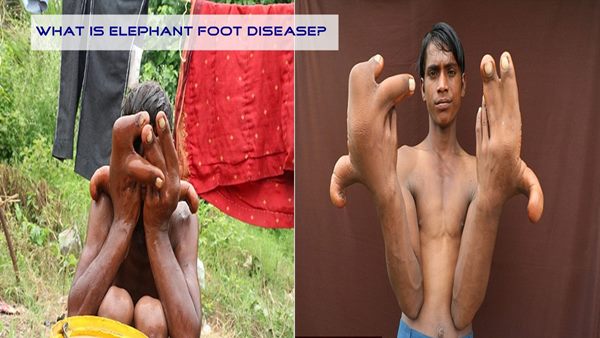 What İs Elephant Foot Diseasa? (Healt)