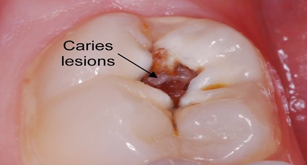 Diş Çürükleri: Aspirin Çürük Dişleri Onarıyor
