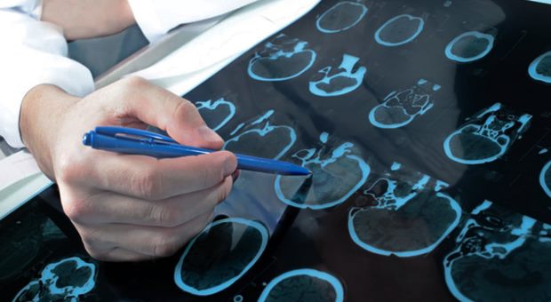 Epilepsi: Epilepsi Hastalarının Tanısı Zorlaşıyor