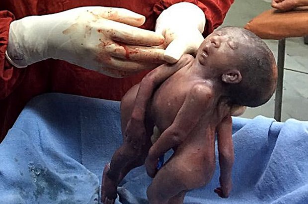 Siamese twins were born at a hospital in eastern India on Friday