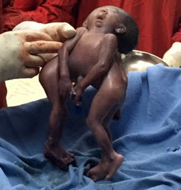 Siamese twins were born at a hospital in eastern India on Friday Siamese twins were born at a hospital in eastern India on Friday