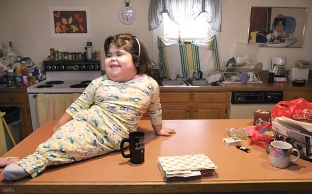 Siamese twins were born at a hospital in eastern India on Friday