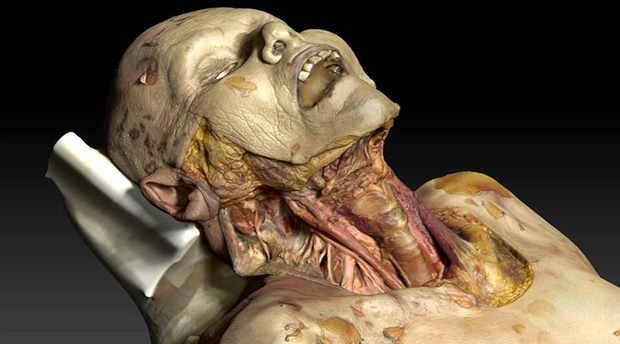 University Creates Virtual Cadaver For Better Examinations – Video