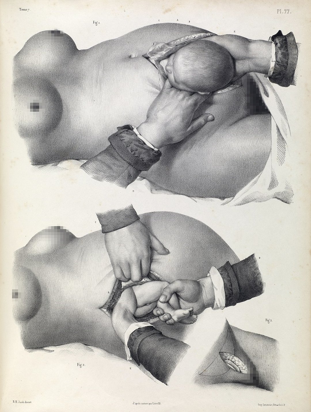 Gruesome images show the barbaric nature of 19th century surgery
