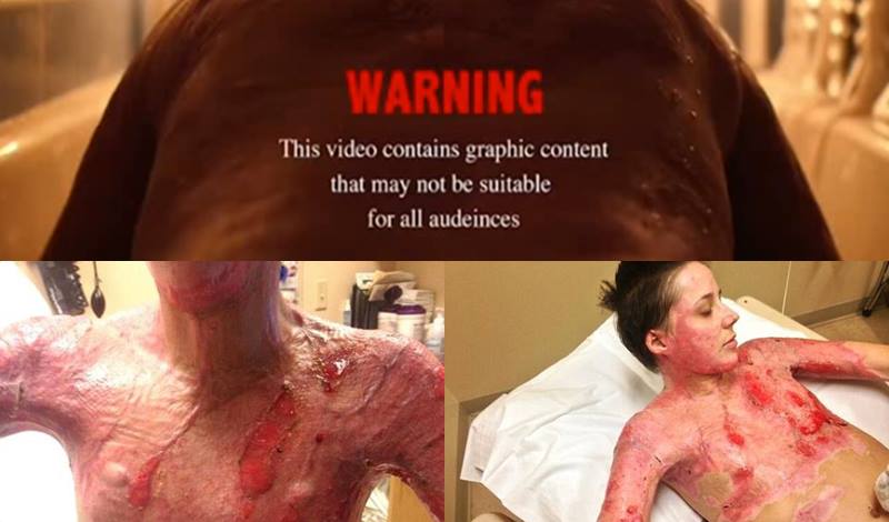 Video: Abuse victim learns to accept her scars after burning herself Video: Abuse victim learns to accept her scars after burning herself