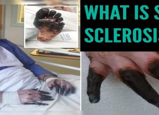 What İs Systemic Sclerosis:Champion bagpiper fingers turned BLACK amputated
