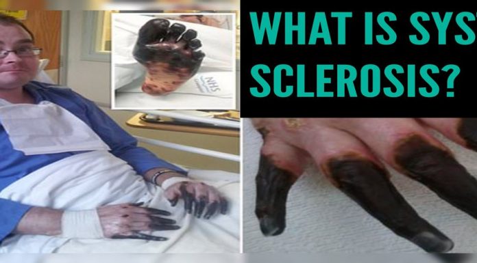 What İs Systemic Sclerosis:Champion bagpiper fingers turned BLACK amputated