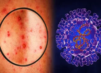 Maymun çiçeği virüsünün görüldüğü ülkelerin sayısı artıyor Hastalık nasıl bulaşıyor