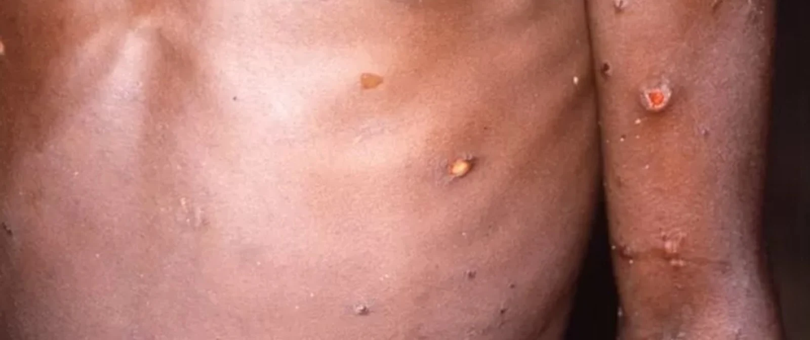 Dünya Sağlık Örgütü (WHO), maymun çiçeği virüsünü "küresel sağlık acil durumu" ilan etti