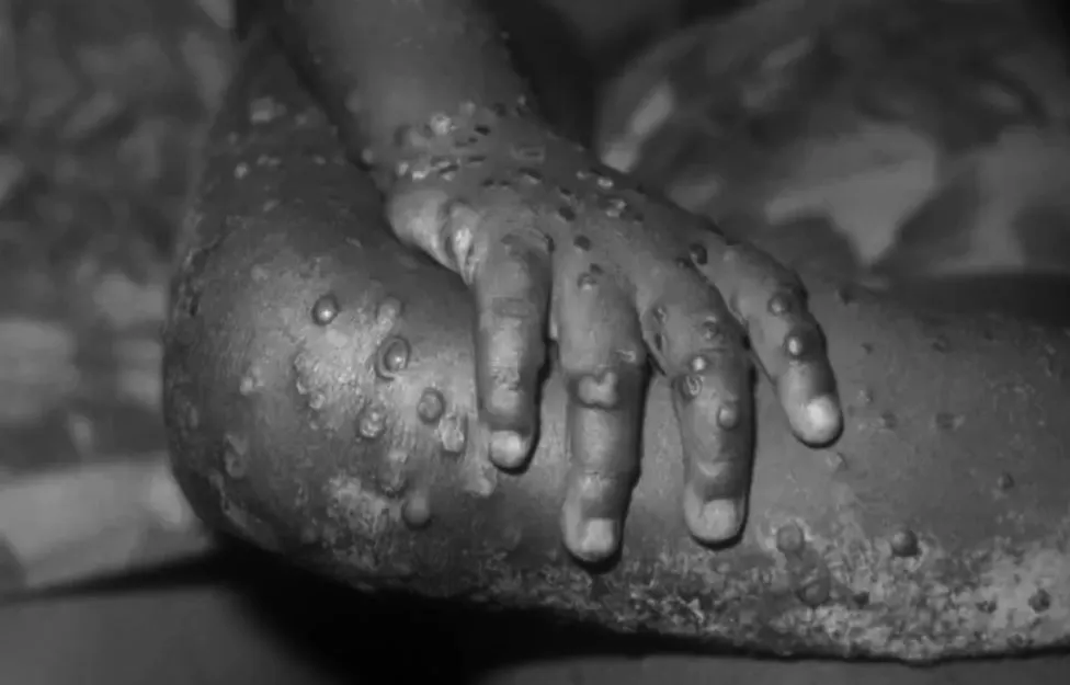 Maymun çiçeği virüsünün görüldüğü ülkelerin sayısı artıyor Hastalık nasıl bulaşıyor