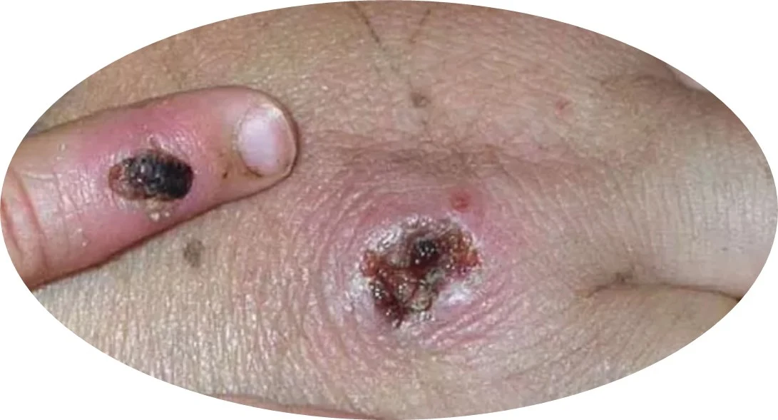 Dünya Sağlık Örgütü (WHO), maymun çiçeği virüsünü "küresel sağlık acil durumu" ilan etti