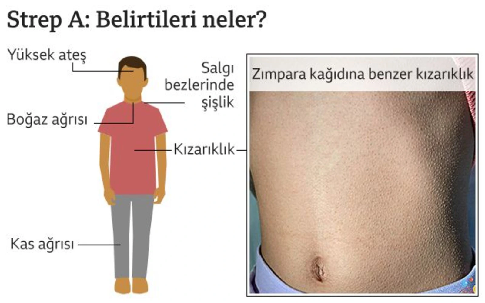 Strep A bakterisi kaynaklı ilk çocuk ölümü Türkiye'de gerçekleşti, Strep A nedir?